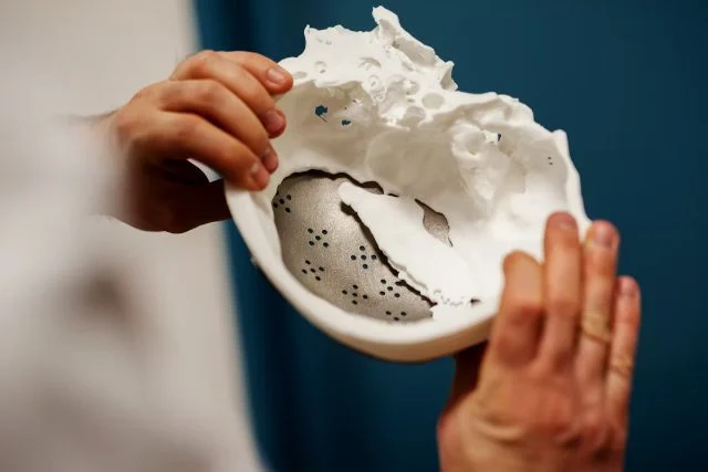 Hands holding a printed cranial model with a perforated implant