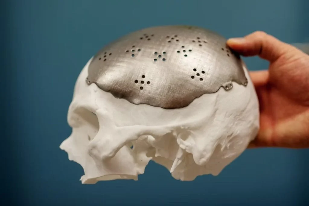 A titanium cranial plate fitted to a printed skull model