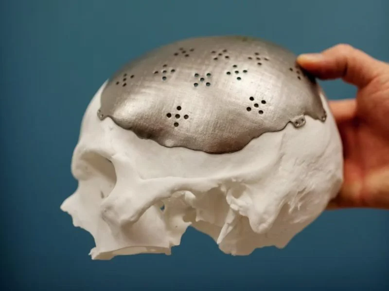 A titanium cranial plate fitted to a printed skull model