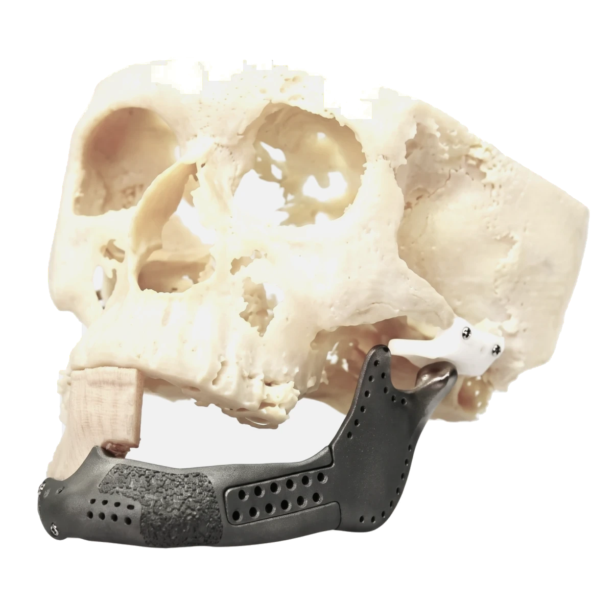 A skull model with a titanium mandibular implant