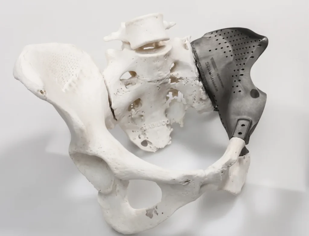 A pelvis model with a patient-specific titanium implant