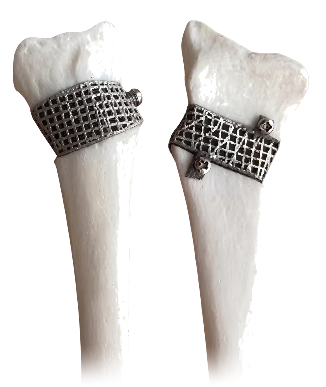 Two bone models with patient-specific titanium bone cages