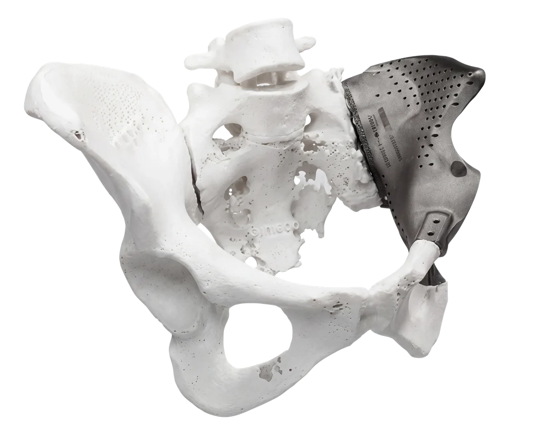 A titanium spinal implant with a porous lattice structure fitted to a vertebral model