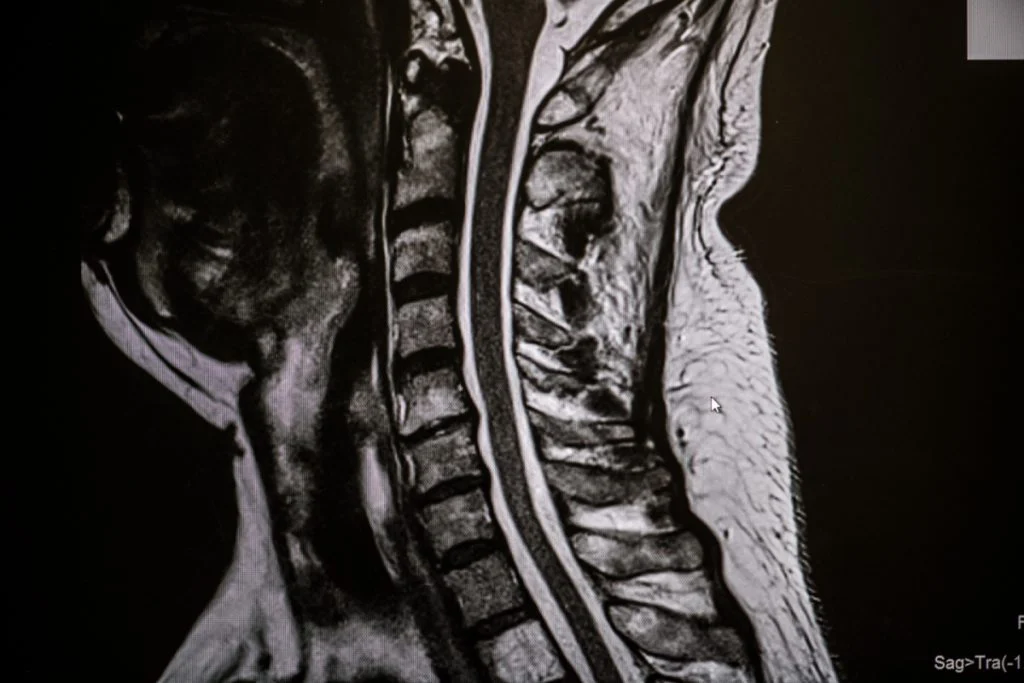 An MRI scan of the cervical spine