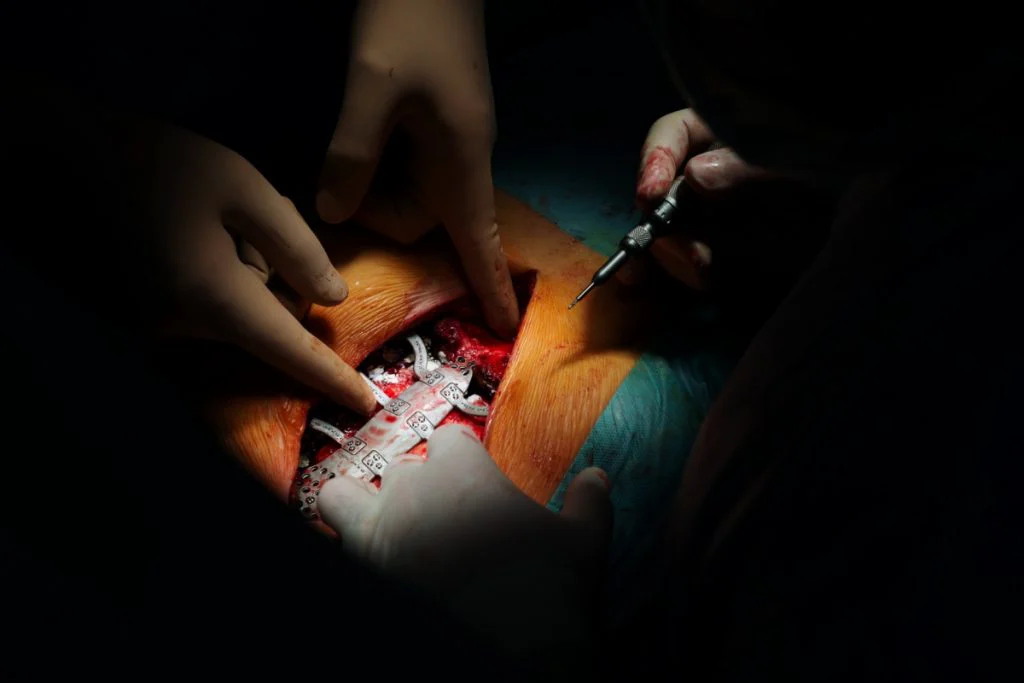 Chirurgovia osádzajú hrudníkový implantát