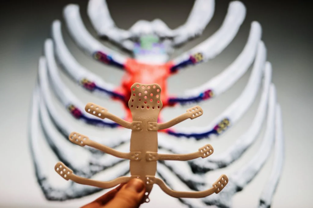 Hrudníkový implantát na vytlačenom modeli hrudného koša